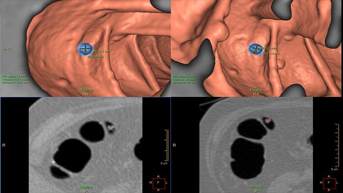 virtual colonoscopy thumbnail