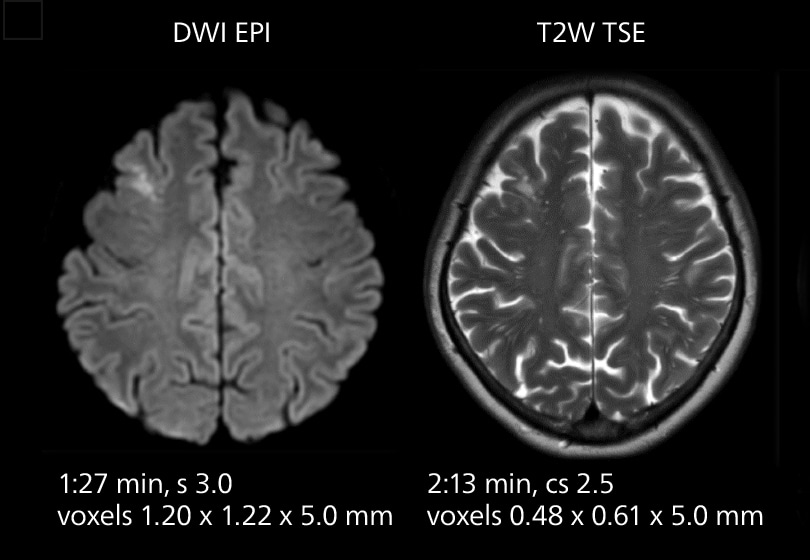 Brain mri two