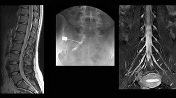 Left sacroiliac arthritis