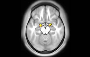 MultiBand SENSE fMRI faces vs places subcort axial