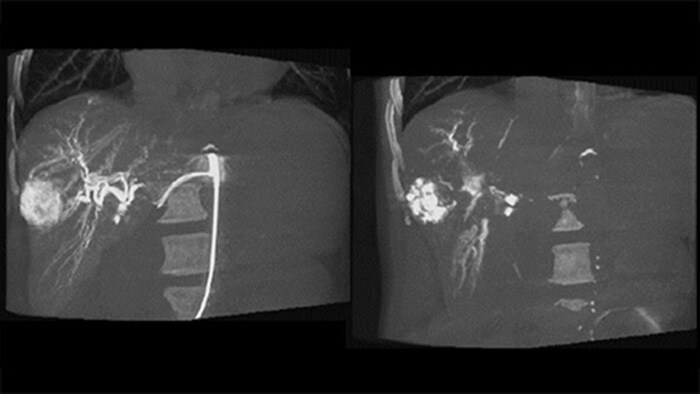 Post embolization 3D imaging with CBCT