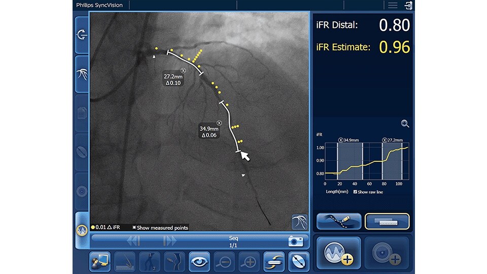 iFR co-registration visuals