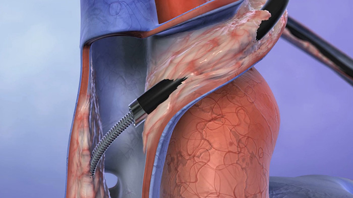 Laser lead extraction animation video