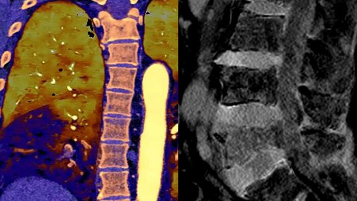 Spectral CT image