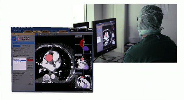 Physicians share experiences with Philips HeartNavigator