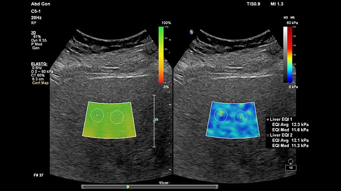 Liver Ultrasound Machines | Philips Healthcare